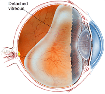 detached vitreous