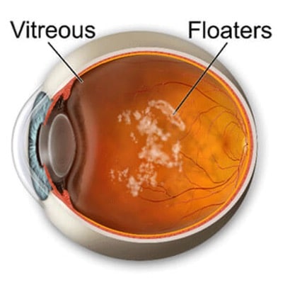 Vitreous fluid with floaters