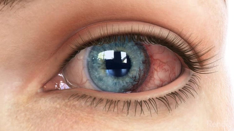 image of an eye displaying signs of corneal neovascularization