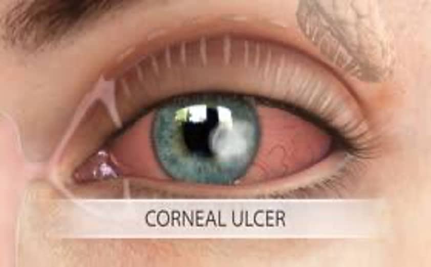 image displaying an eye with a corneal ulcer